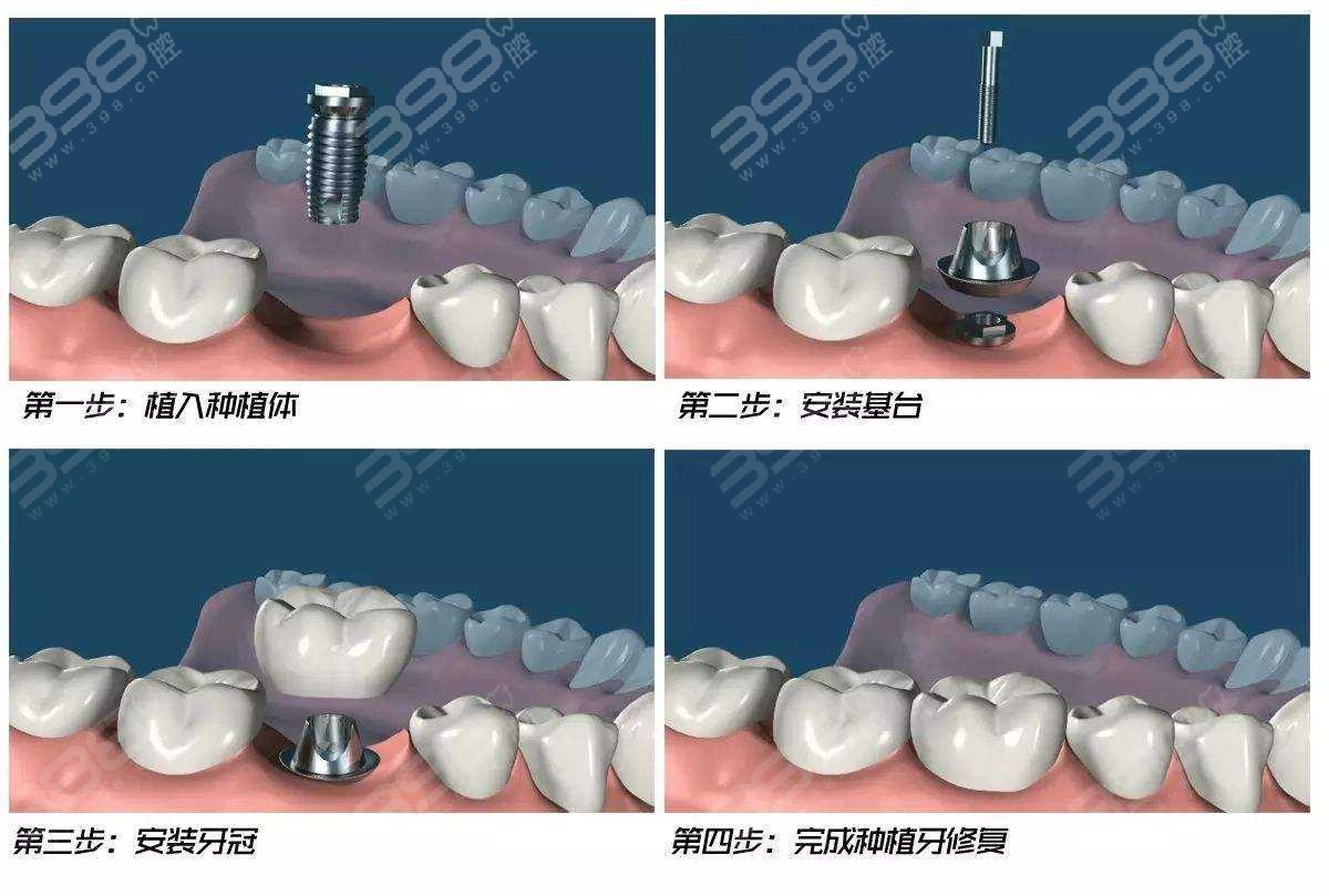 种植牙种植过程示意图