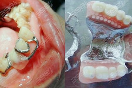 西安林牙立齿口腔门诊部义齿修复技术