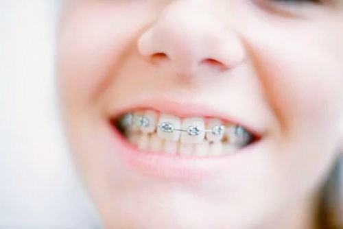 12岁矫正牙齿要多久？费用大概多少钱？会反弹吗？