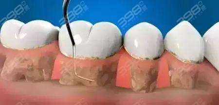 牙周探诊深度分级分析：什么程度需要龈下刮治？