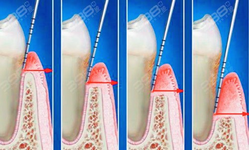 牙周探诊深度分级分析：什么程度需要龈下刮治？
