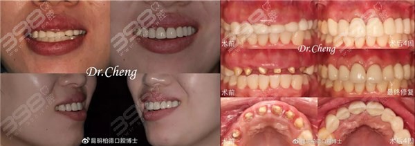 牙齿美学修复案例
