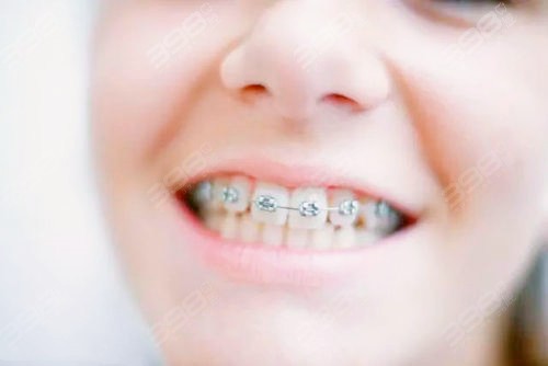 12岁矫正牙齿要多久？费用大概多少钱？会反弹吗？