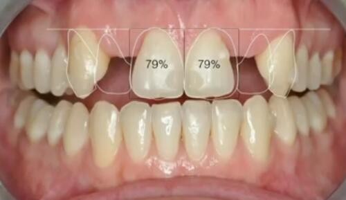 微创种植牙的条件是什么？瑞士士卓曼种植牙能用多久？