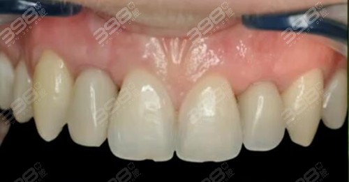 微创种植牙的条件是什么？瑞士士卓曼种植牙能用多久？
