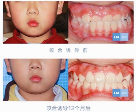 罗慕儿童咬合诱导早期牙齿矫正有效吗？多少钱一套？