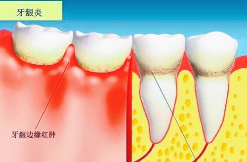 牙龈炎症状和牙周炎有什么区别？牙龈炎治疗需要多少钱？