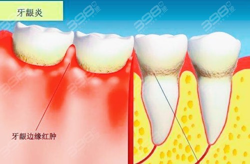 牙龈炎症状和牙周炎有什么区别？牙龈炎治疗需要多少钱？