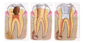 牙体牙髓疾病示意图