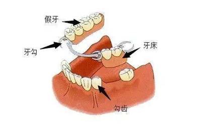 活动假牙结构