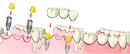 种植牙修复过程