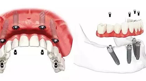 半口种植牙手术怎么做？