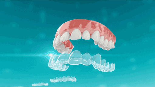 隐形牙齿矫正