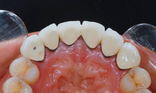 北京烤瓷牙多少钱？钴铬合金牙寿命多久？对身体有害吗？