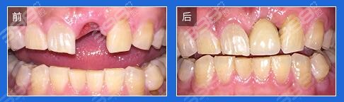 北京圣贝口腔又有种植牙美学修复案例