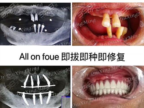 北京雅医家口腔医院全口种植牙案例