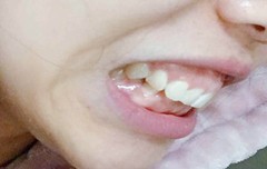 感觉牙齐嘴巴突，这种牙齿整齐但是嘴巴前凸需要矫正吗？