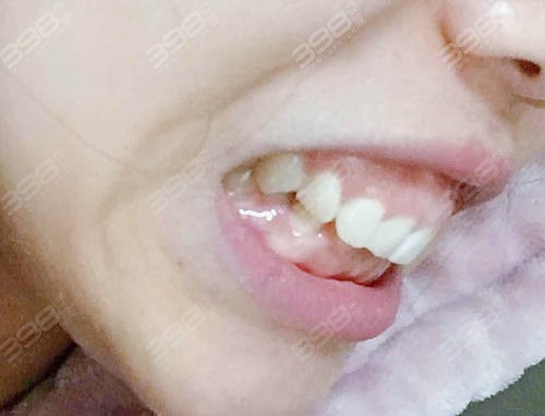 感觉牙齐嘴巴突，这种牙齿整齐但是嘴巴前凸需要矫正吗？