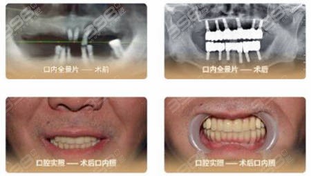 北京中诺口腔全口种植牙案例
