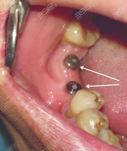 同步齿科种植牙技术怎么样？