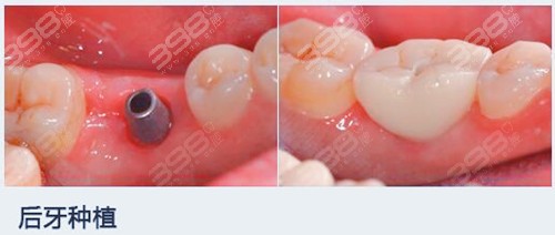 深圳同步齿科后磨牙美学种植案例