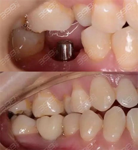 重庆牙博士口腔种植病例