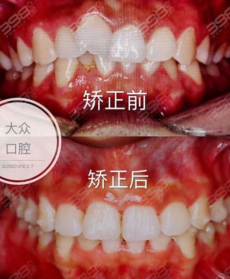 襄阳大众口腔牙齿矫正前后案例