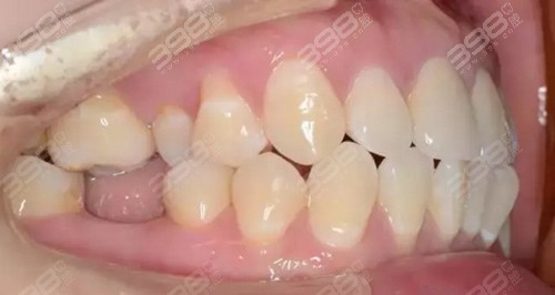 重庆牙博士口腔种植病例