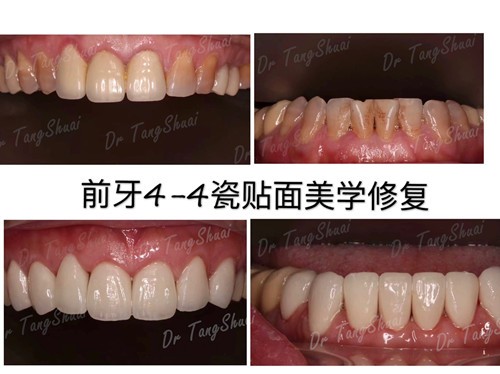 北京雅医家口腔门诊部牙齿瓷贴面案例