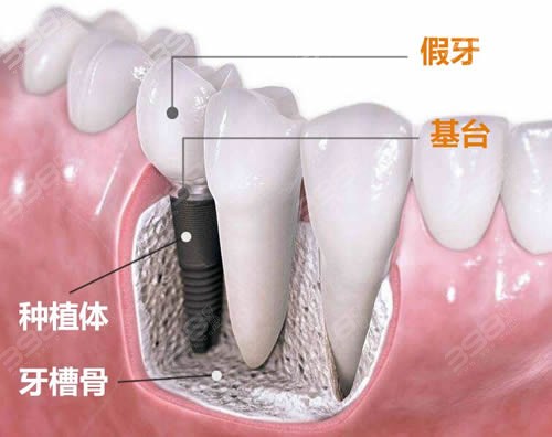 镶牙和种植牙的区别