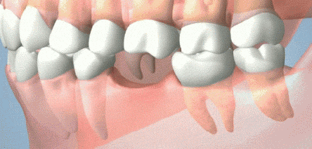 牙齿缺失的危害