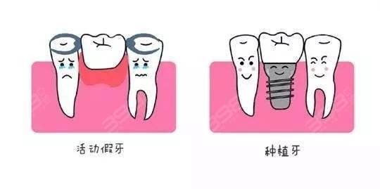 镶牙和种植牙的区别