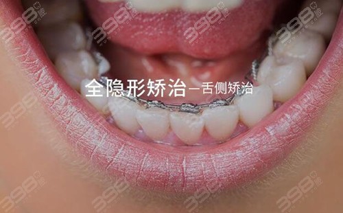 北京斯迈尔口腔舌侧隐形牙齿矫正