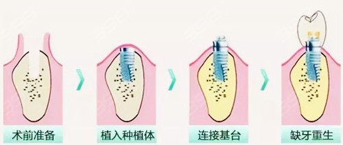 杭州余杭口腔医院种植牙技术好不好