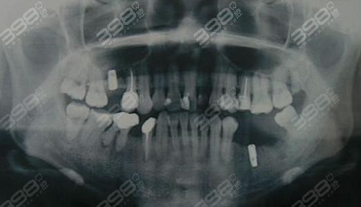 上颌窦提升牙种植术