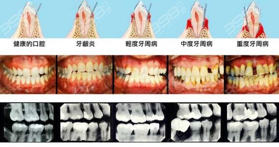 种植牙的过程步骤详解