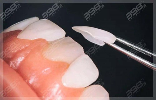 牙齿发黄、牙缝过大、牙齿断裂怎么办？超薄牙贴面来帮忙