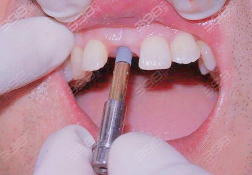 前牙美学种植案例