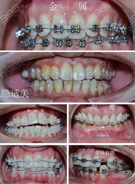 北京西诺口腔门诊部牙齿矫正