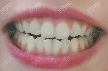 牙性偏颌示意图