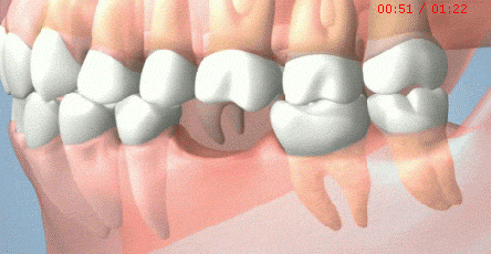 长期缺牙的危害