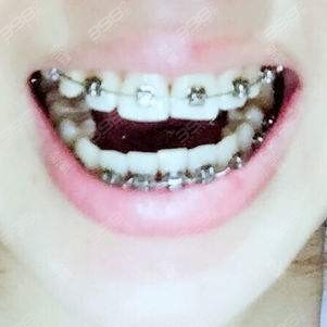 牙齿矫正案例