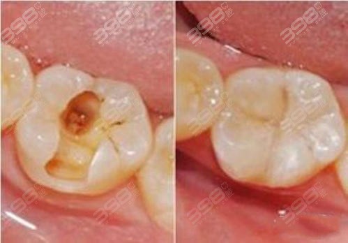树脂补牙案例对比