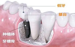 北京种植牙医生：种牙的好处与弊端，种植牙寿命是多少年