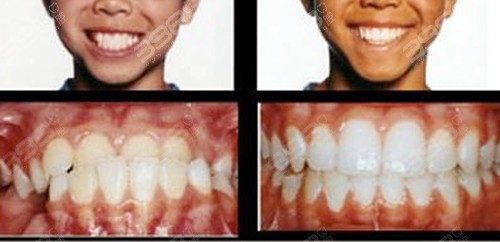 标准的牙齿咬合图片是什么样？