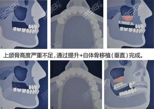 上颌窦提升牙种植术示意图