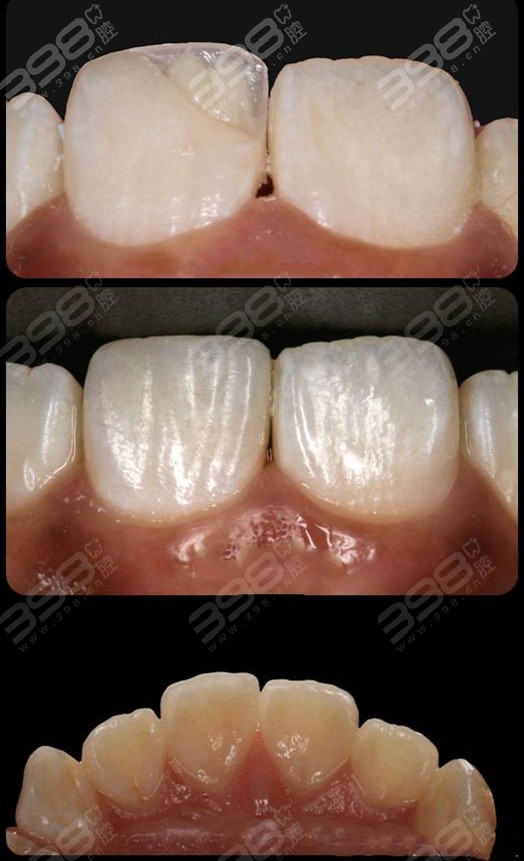 牙齿仿生美学修复案例对比