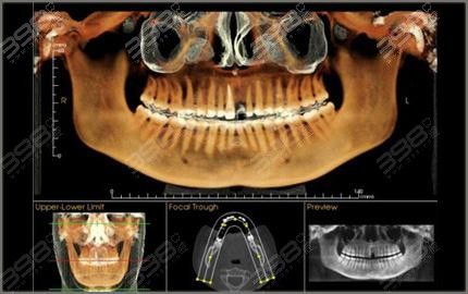 种植牙术前全景CT