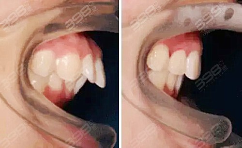 牙性和骨性龅牙对比照来了