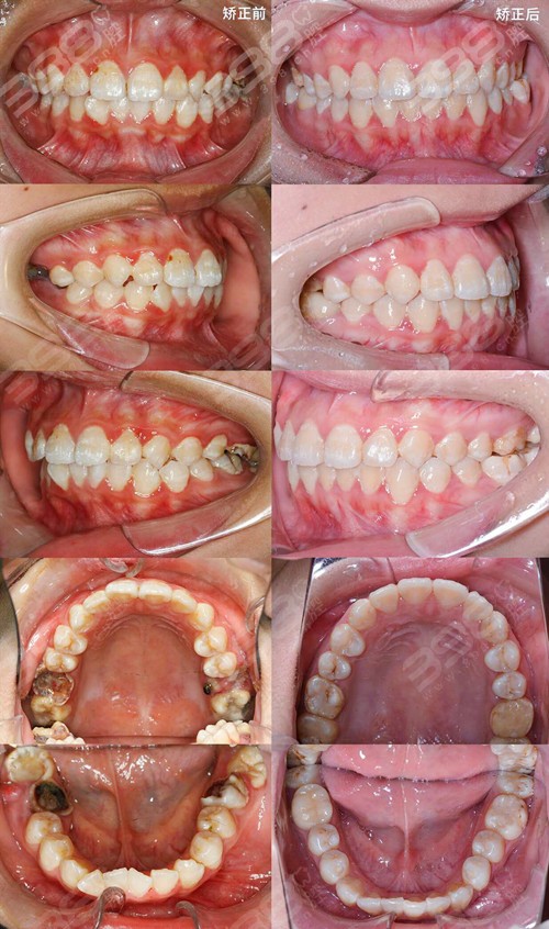 牙齿矫正过程及真实经历